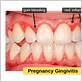 inflamed gums early pregnancy