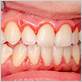 is gingivitis gum disease contagious