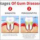 is gum disease a dental emergency