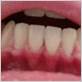 is my gum disease reversible