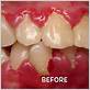 is severe gum disease curable