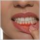 itchy gums gum disease
