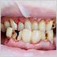 jupiter gum disease