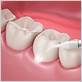 laser dental treatment for gum disease