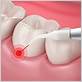 laser gum disease cost