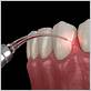 laser gum disease treatment fort worth tx