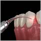 laser therapy for gum disease