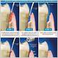 laser treatment for periodontal gum disease