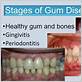 last stage of gum disease