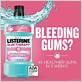 listerine gum therapy before and after