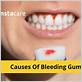 liver disease gum bleeding