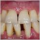 loose teeth due to gum disease