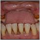 lost teeth due to gum disease