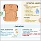 lymph nodes gum disease