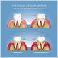 main causes of gum disease