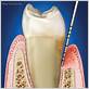 measuring pockets in gums