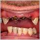 methamphetamine gum disease