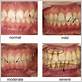 mild periodontitis treatment