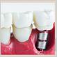 mini dental implants gum disease