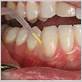 minocycline for gum disease