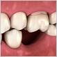missing teeth can cause gum disease