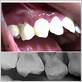 molar/incisor pattern periodontitis