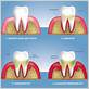 molar gum inflammation