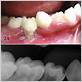 molar incisor pattern periodontitis