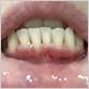 mumsnet gum disease