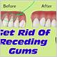 natural gum disease method