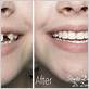 no waterpik after dental implant surgery