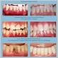 non surgical gum disease treatment ballwin mo