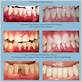 non-surgical gum disease therapy