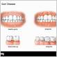 normal gums vs gum disease