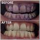 oral b electric toothbrush before and after