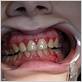 paget's disease bleeding gums