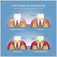 paradoxical gum disease