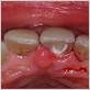 parasites gum disease