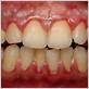 patients with disorders of the gums have ____ disease