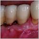 peri implant mucositis pictures