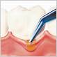 periochip gum disease