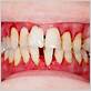 periodontal/gum disease conroe