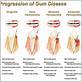 periodontal/gum disease san francisco