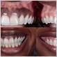 periodontal disease black gums