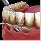 periodontal disease treatments