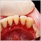 periodontal disease without bleeding gums