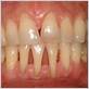 periodontal gum disease en español
