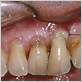 periodontal gum disease pus