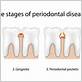 periodontal gum disease queens