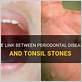 periodontal gum disease tonsil stones